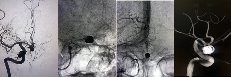 Tratamiento con coils OPTIMA<br />(Drs. Giacobbe y Besada)