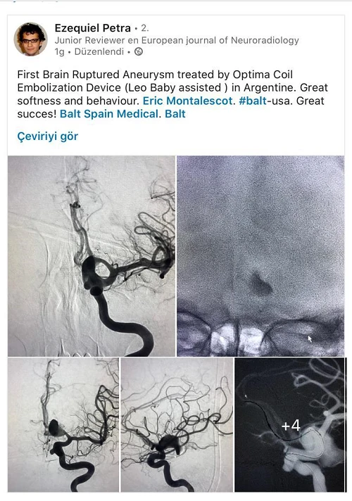 Tratamiento con coils OPTIMA (Dr. Ezequiel Petra)