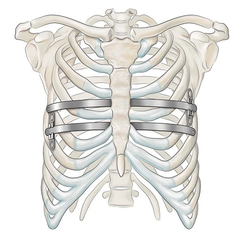 PES - Pectus Excavatum