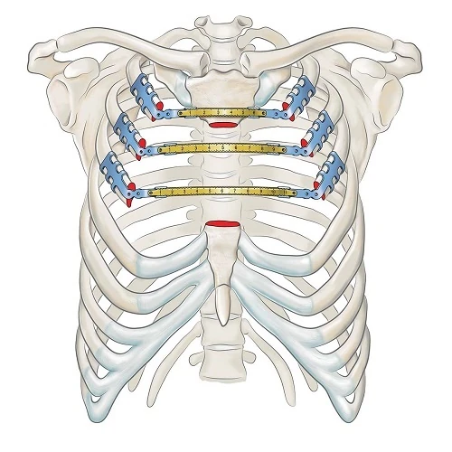 STRATOS - Reconstrucción de Esternón